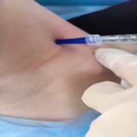 multi injector needle