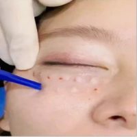 multi injector needle