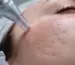 Microneedling for Acne Scars